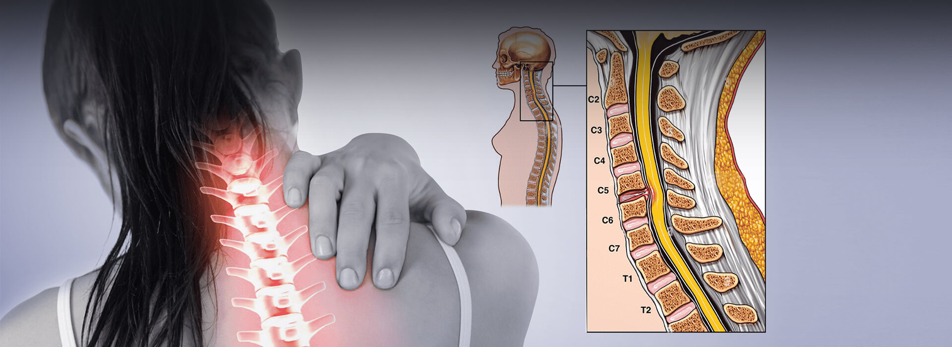cervical canal stenosis