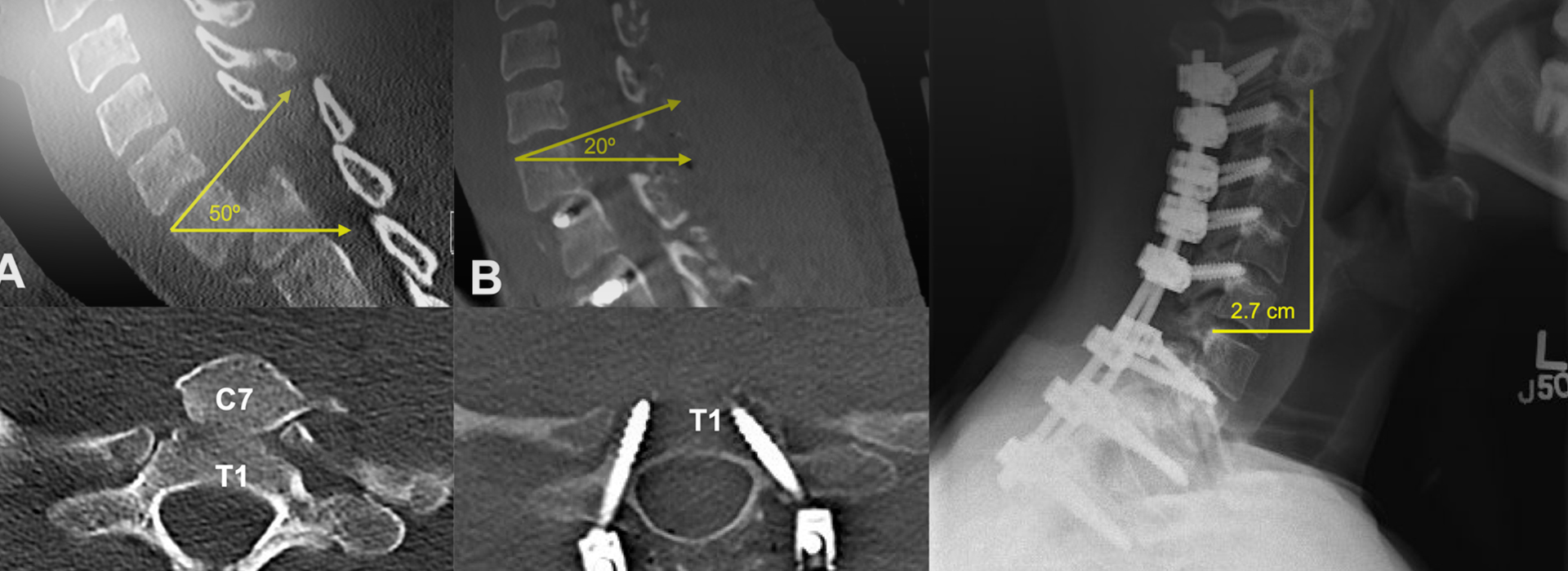 Is Spondyloptosis Dangerous? When to Seek Medical Care? Relief Is Spondyloptosis Dangerous? When to Seek Medical Care? Relief